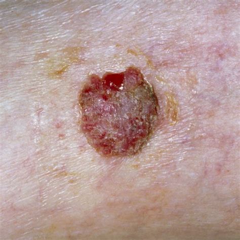 皮膚癌|Skin Cancer: Symptoms, Types & Treatment